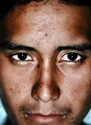 After Image: Venous Malformation - front