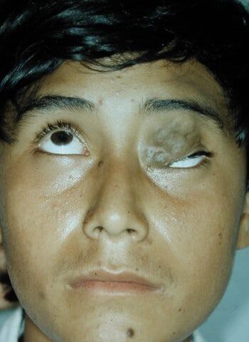 Before Image: Venous Malformation - front