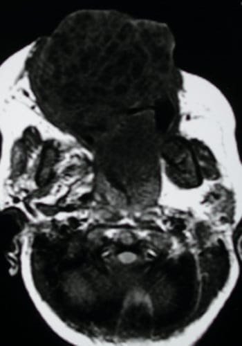 After Image: Craniofacial Tumor - front