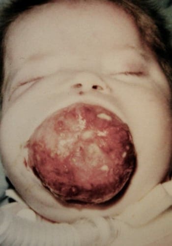 Before Image: Craniofacial Tumor - front