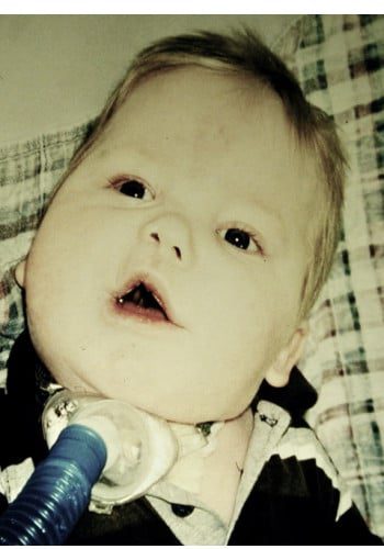 After Image: Craniofacial Tumor - front