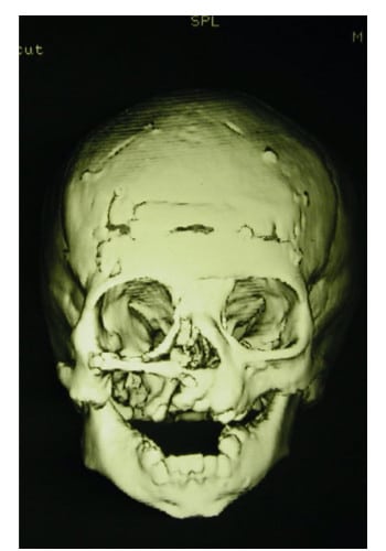 Before Image: Craniofacial Tumor - front