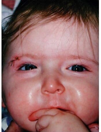 After Image: Craniosynostosis - front