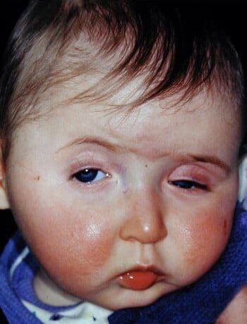 Before Image: Craniosynostosis - front