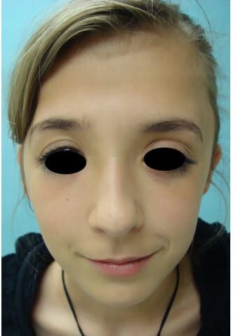 After Image: Craniosynostosis - front