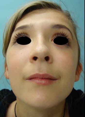Before Image: Craniosynostosis - front