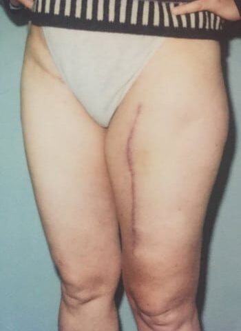 After Image: Liposarcoma - front
