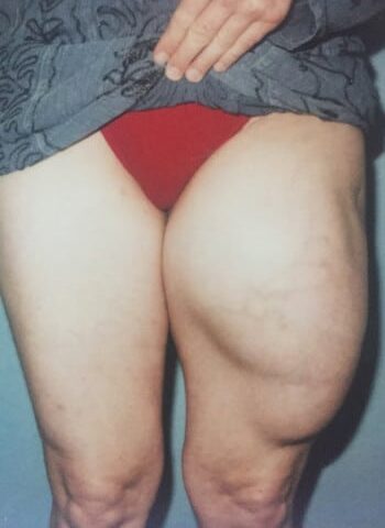 Before Image: Liposarcoma - front