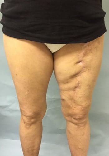 After Image: Liposarcoma - front