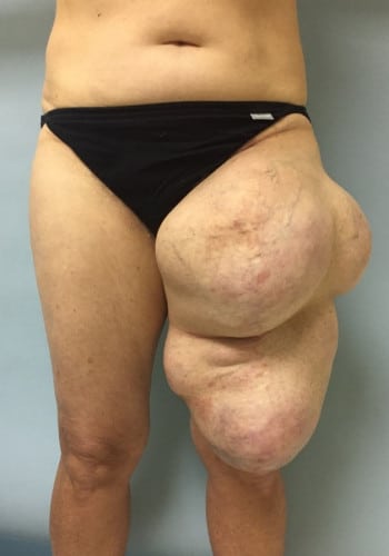 Before Image: Liposarcoma - front