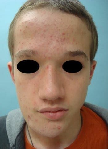 After Image: Neurofibromatosis Case Study 4 – Complex Reconstruction - front
