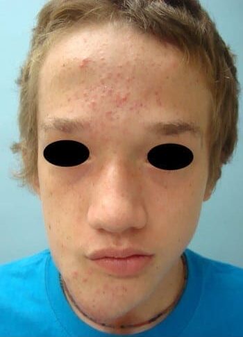 Before Image: Neurofibromatosis Case Study 4 – Complex Reconstruction - front