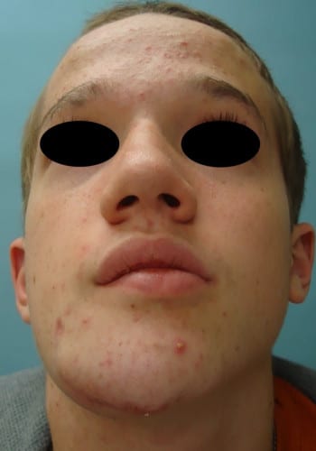 After Image: Neurofibromatosis Case Study 4 – Complex Reconstruction - front