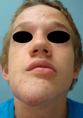 Before Image: Neurofibromatosis Case Study 4 – Complex Reconstruction - front