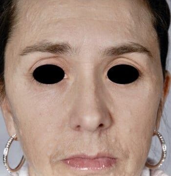 After Image: Neurofibromatosis Case Study 3 – Patient Transformation - front