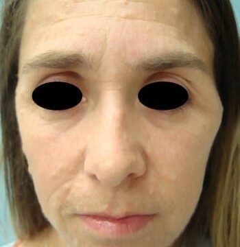 Before Image: Neurofibromatosis Case Study 3 – Patient Transformation - front