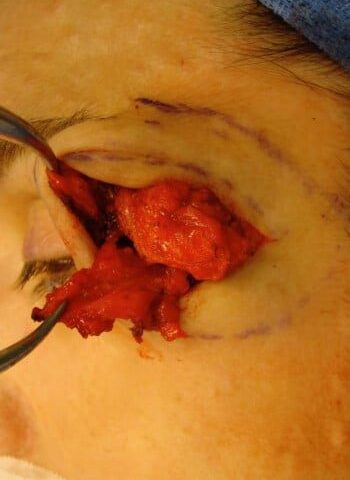 After Image: Neurofibromatosis Case Study 3 – Patient Transformation - left-front-oblique