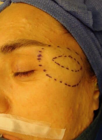 Before Image: Neurofibromatosis Case Study 3 – Patient Transformation - left-front-oblique