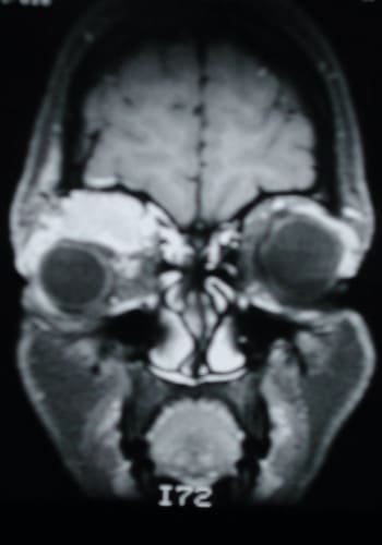After Image: Craniofacial Tumor - front