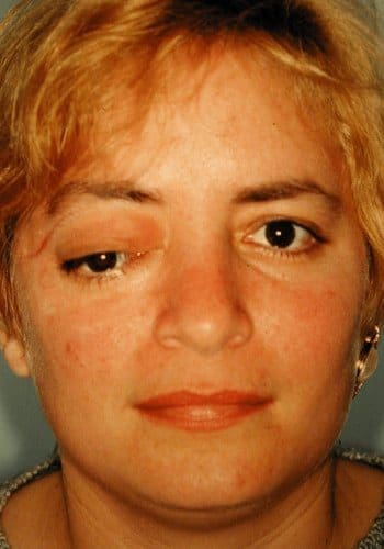 Before Image: Craniofacial Tumor - front
