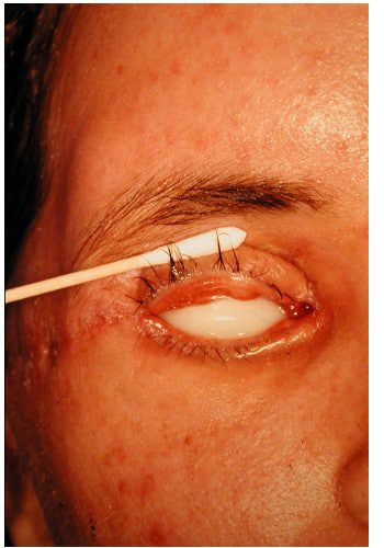 After Image: Craniofacial Tumor - front