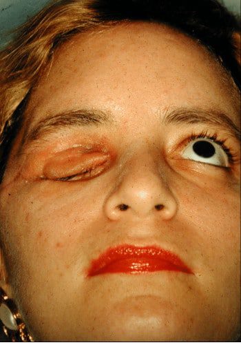 Before Image: Craniofacial Tumor - front
