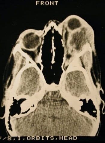 After Image: Craniofacial Tumor - front