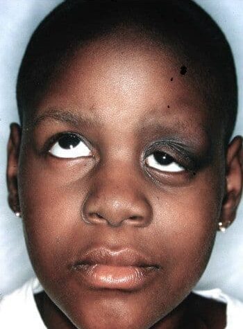 Before Image: Craniofacial Tumor - front