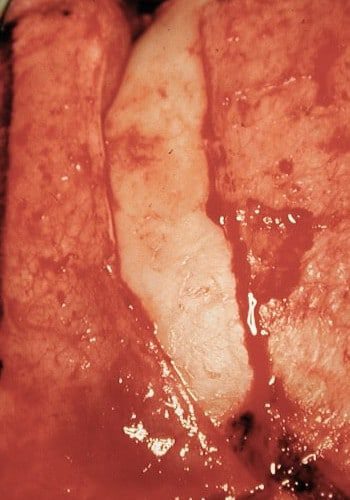 After Image: Craniofacial Tumor - front