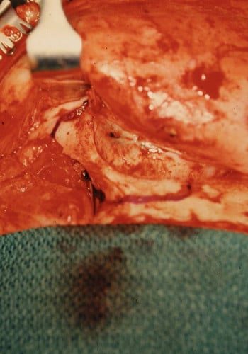 Before Image: Craniofacial Tumor - front