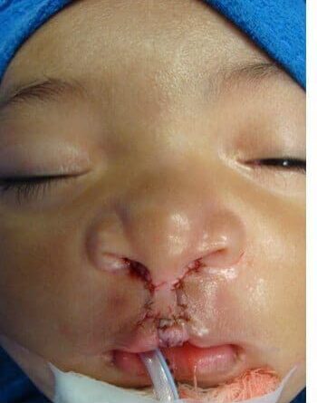 After Image: Cleft Lip - front