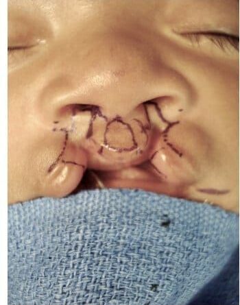 Before Image: Cleft Lip - front