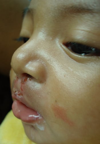 After Image: Cleft Lip - other