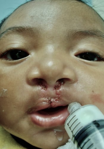 Before Image: Cleft Lip - other