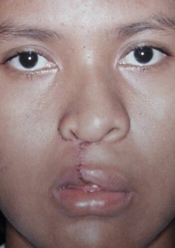 After Image: Cleft Lip - front