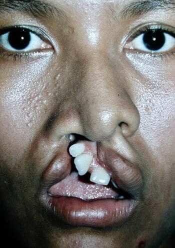 Before Image: Cleft Lip - front