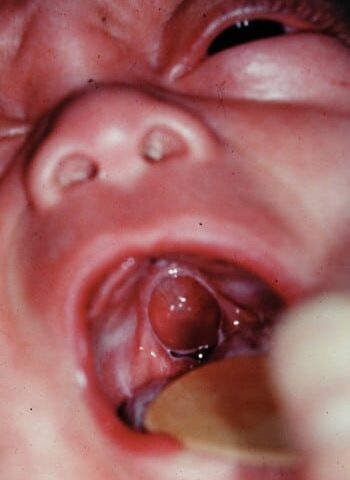 After Image: Encephalocele - front