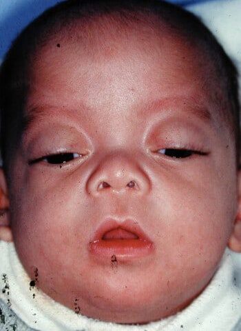 Before Image: Encephalocele - front