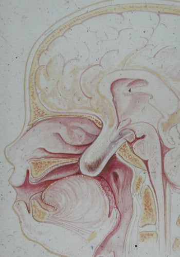 After Image: Encephalocele - left-side