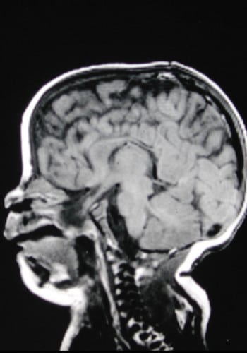 Before Image: Encephalocele - left-side