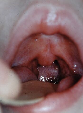After Image: Encephalocele - front