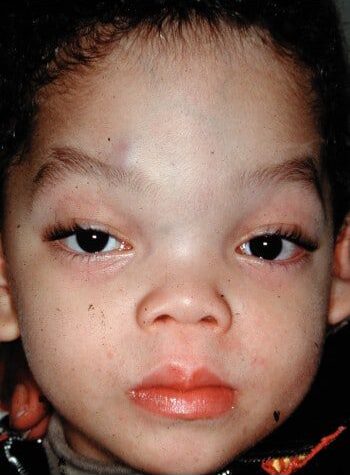 Before Image: Encephalocele - front