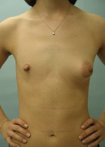 Before Image: Asymmetric Breasts - front