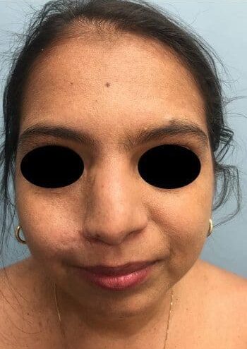 After Image: Neurofibromatosis - front