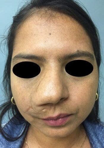 Before Image: Neurofibromatosis - front