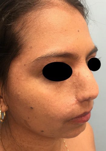 After Image: Neurofibromatosis - right-front-oblique