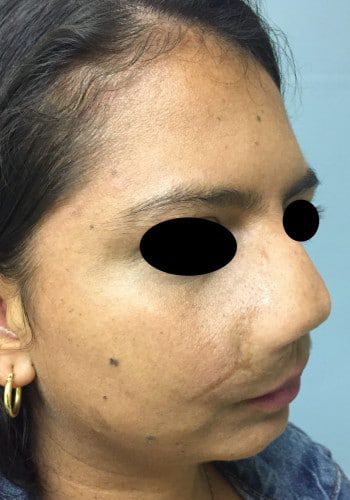 Before Image: Neurofibromatosis - right-front-oblique