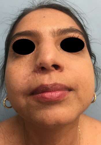 After Image: Neurofibromatosis - front