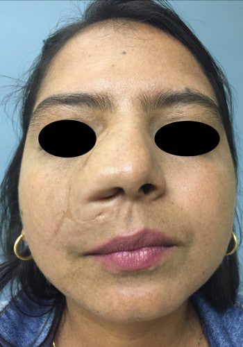 Before Image: Neurofibromatosis - front