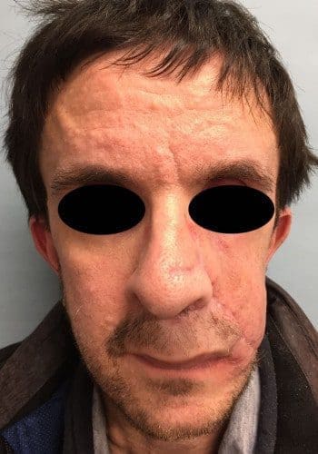 After Image: Neurofibromatosis Case Study 2 – Surgical Insight - front